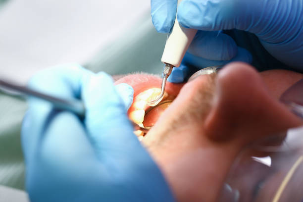 Best Emergency Dentist for Knocked-Out Tooth in Mentone, IN